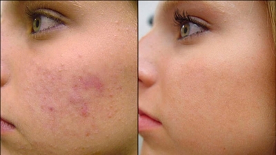 Peeling Facial Ultrasónico