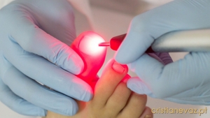 Laser Podológico - A Revolução no Tratamento de Onicomicose