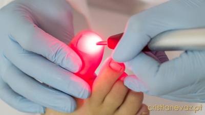 Laser Podológico - A Revolução no Tratamento de Onicomicose